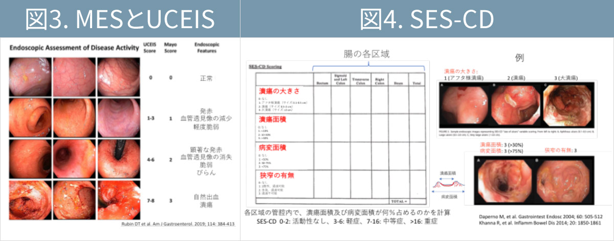 クローン病の大腸内視鏡検査では何が起こるのですか?